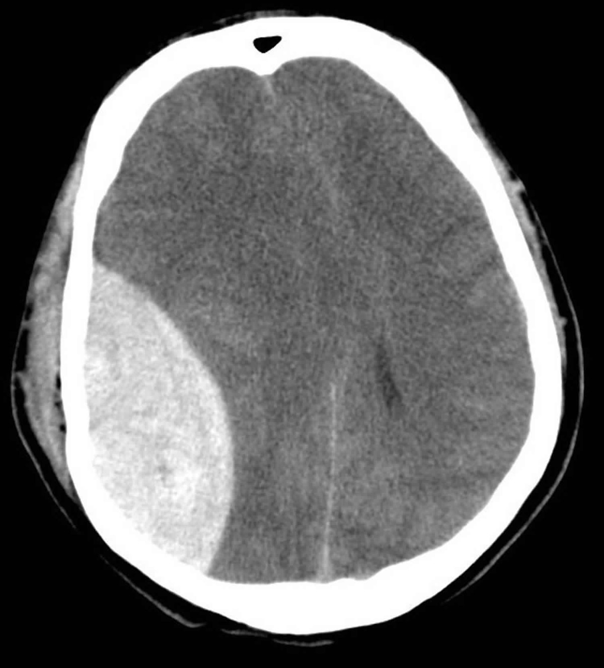 CT scan showing biconvex hyperdensity typical of extradural haematoma
