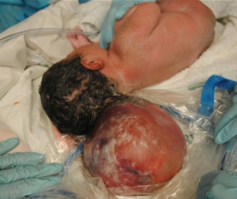 Encephalocele Image