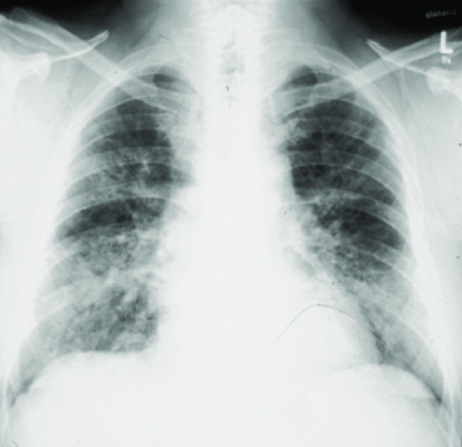 HRCT of Farmer's Lung