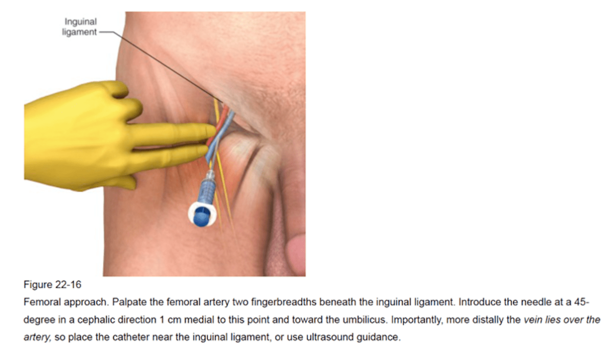 Femoral vein cannulation technique