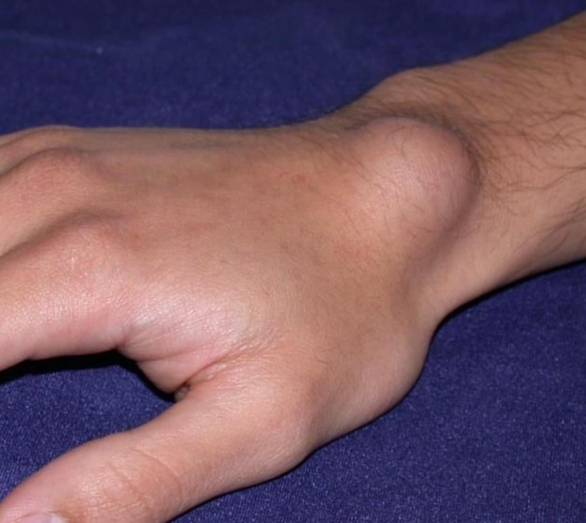 Ganglion cyst illustration
