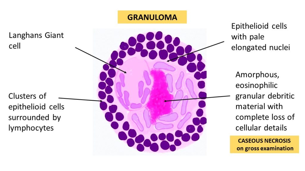Granuloma histology