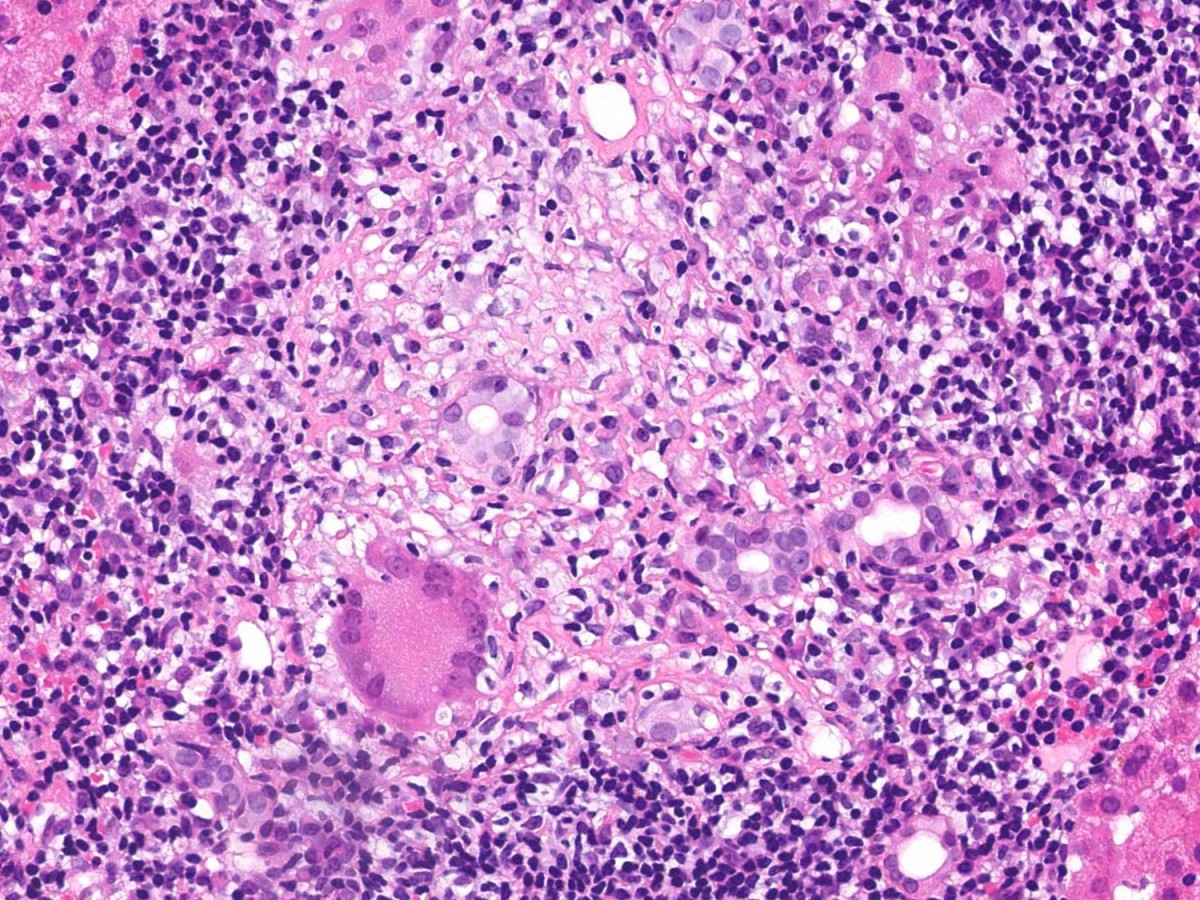 Granuloma pathology