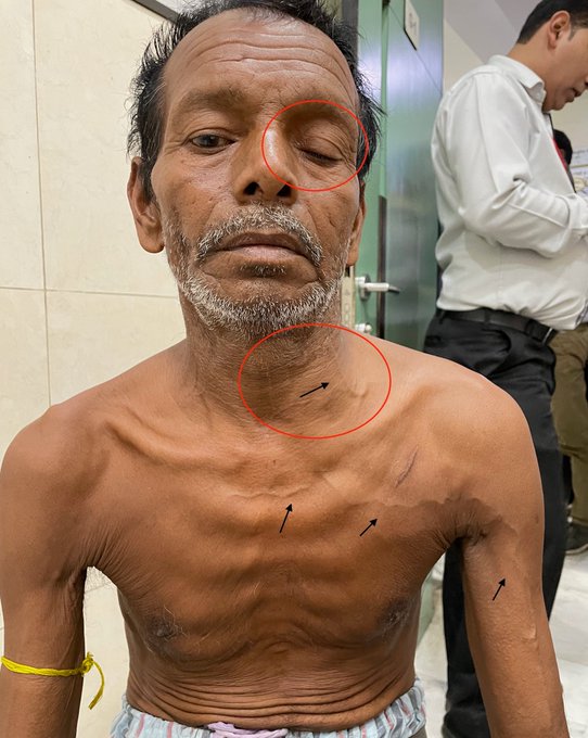 Horner's Syndrome