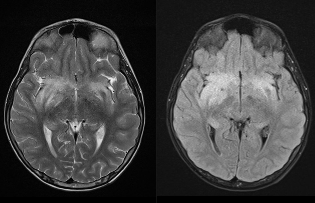Temporal lobe HSVE changes