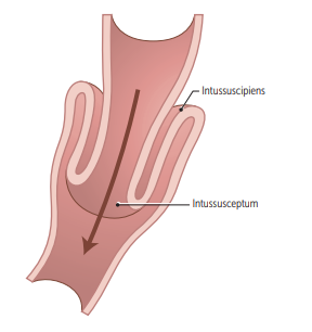 Adult Intussusception diagram
