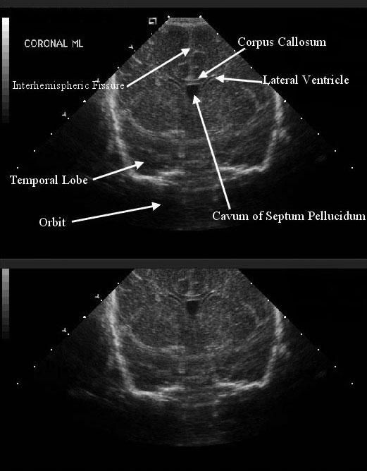 IVH in neonates