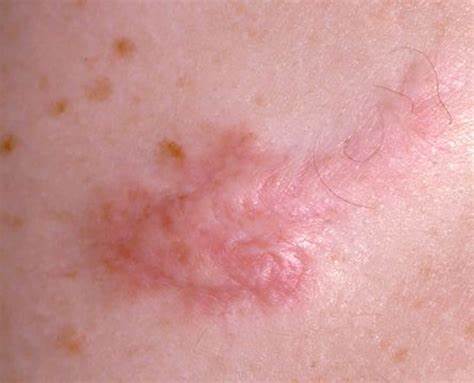 Large keloid on chest