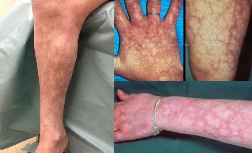 Livedo Reticularis Rash