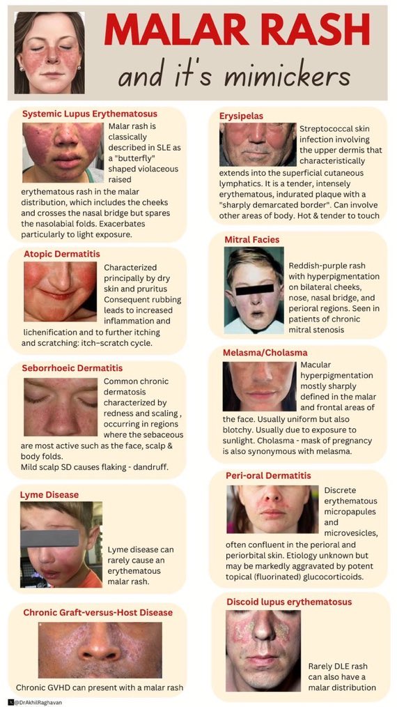 Malar rash clinical image