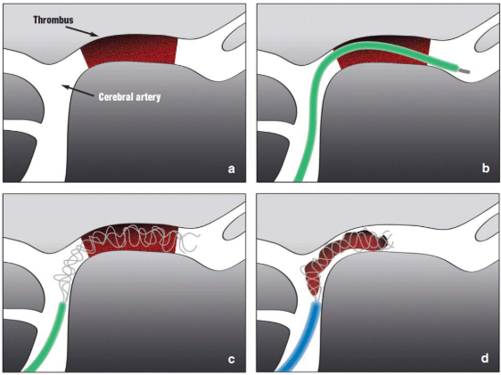 Thrombectomy device