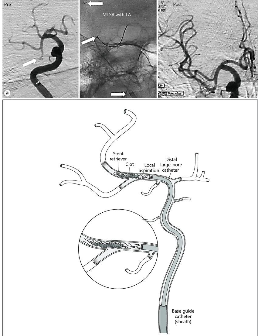 Clot removal angiography
