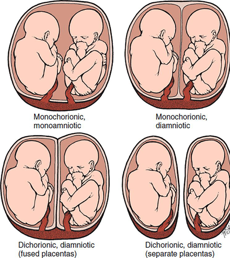 Twin pregnancy diagram