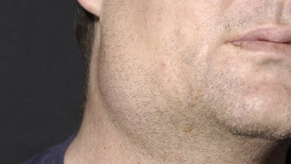 Mumps parotid swelling