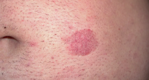 Mycosis Fungoides Clinical Image