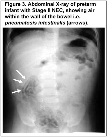 NEC abdominal X-ray