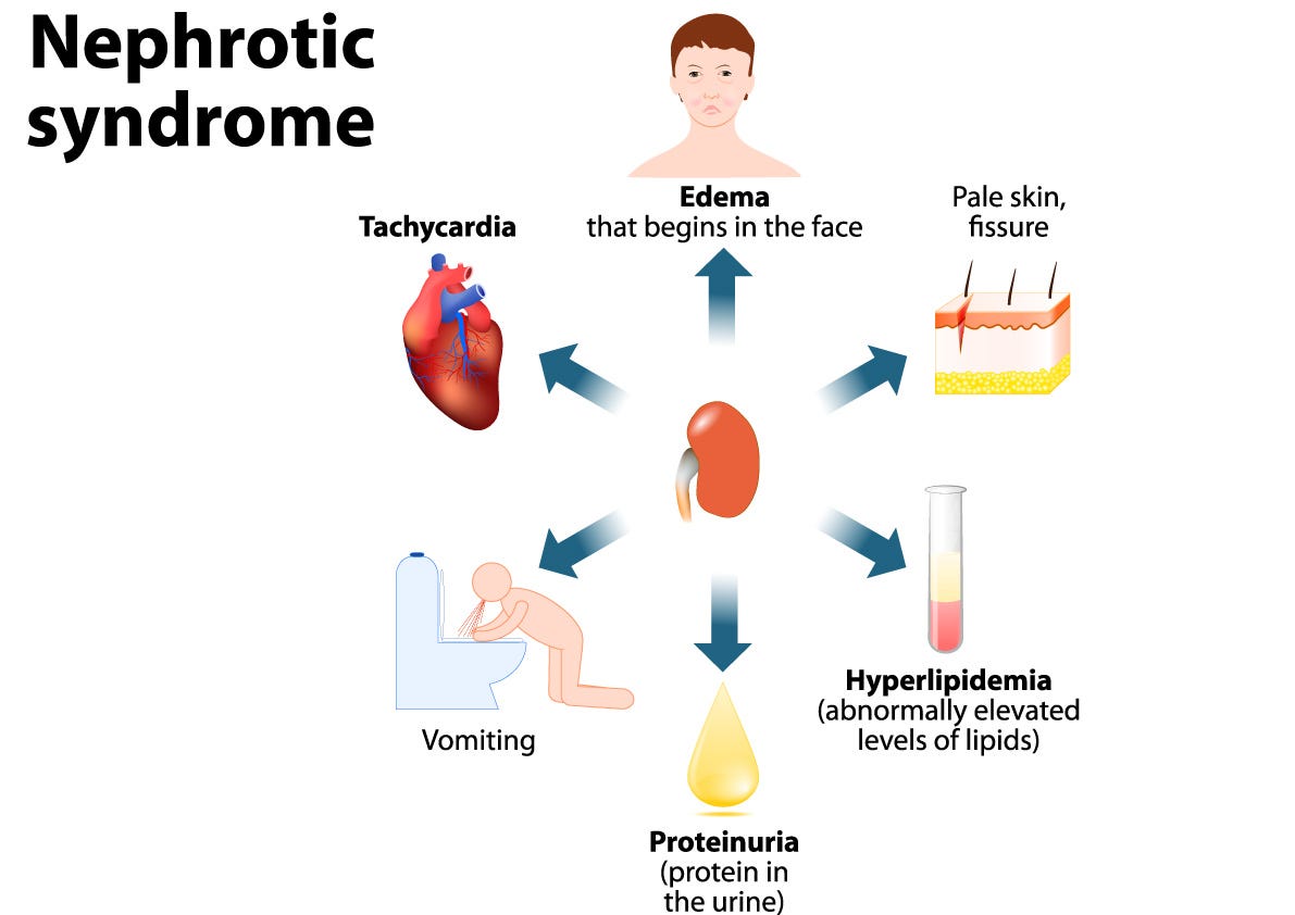 Nephrotic syndrome diagram