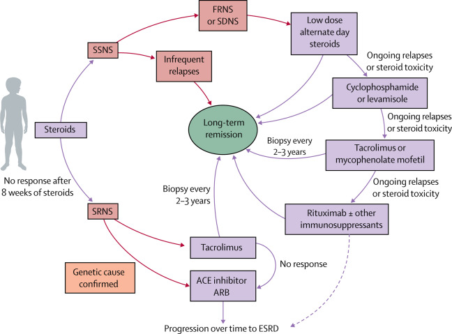 Child with nephrotic syndrome oedema