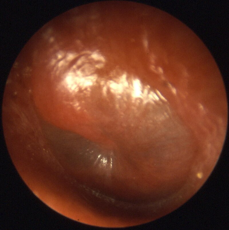Otitis Media inflamed eardrum