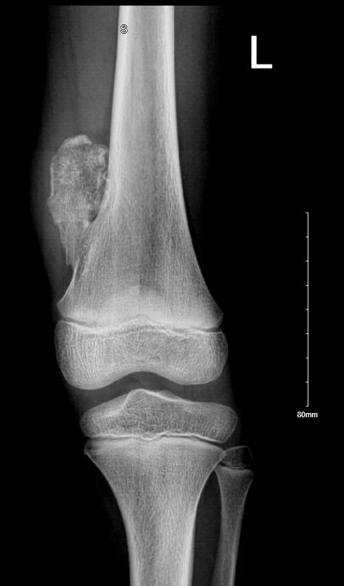 Osteochondroma X-ray