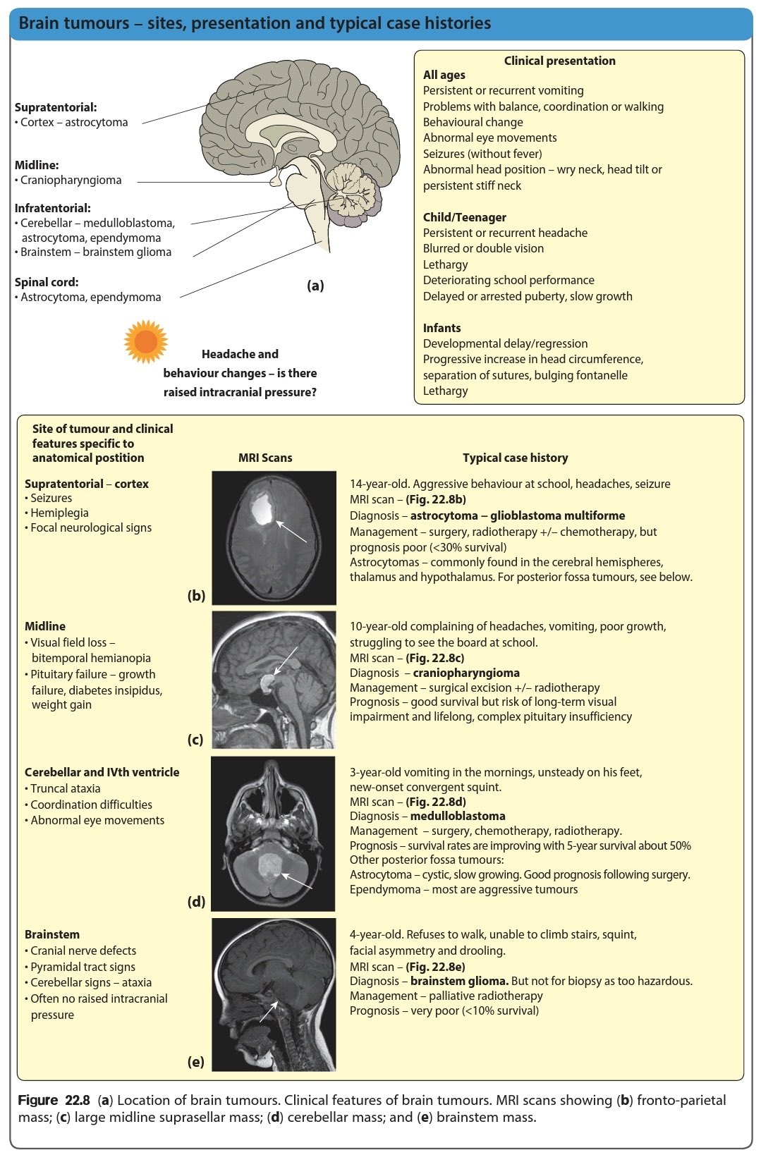 Paediatric brain tumour MRI