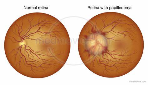Papilloedema