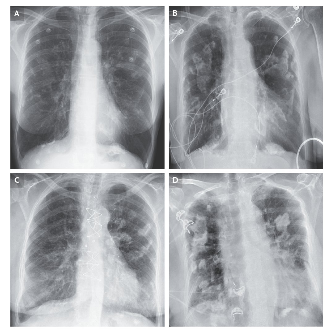 Pleural plaques