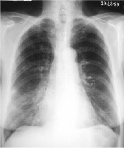 Bronchopneumonia histopathology