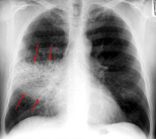 Interstitial pneumonia with ground-glass changes