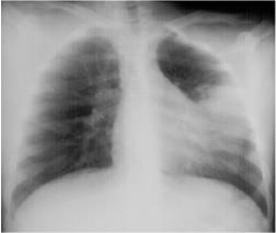 Complication of pneumonia – abscess