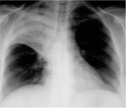 Lobar pneumonia pathology