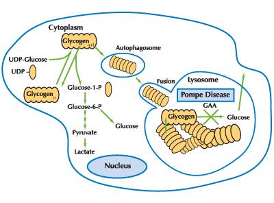 Pompe disease lysosomal glycogen diagram