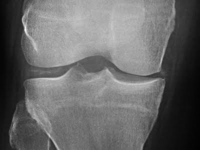 Chondrocalcinosis X-ray