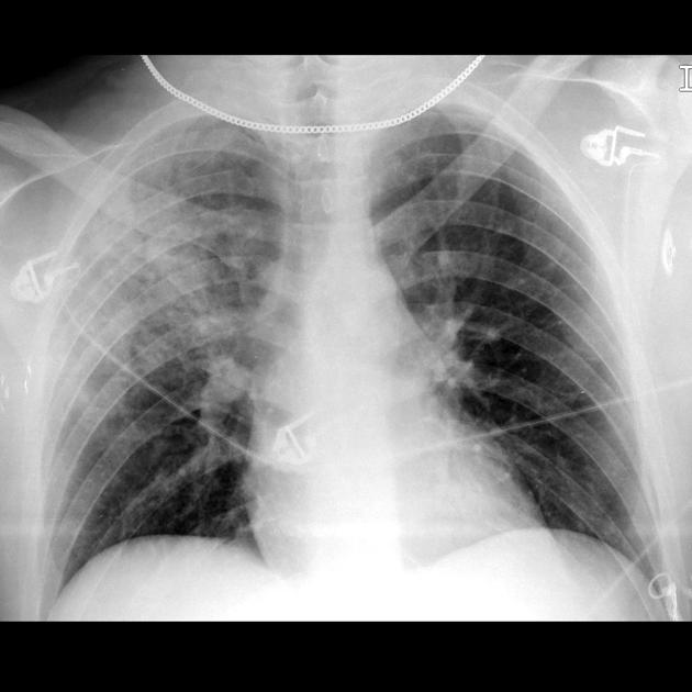 Pulmonary Haemorrhage CXR