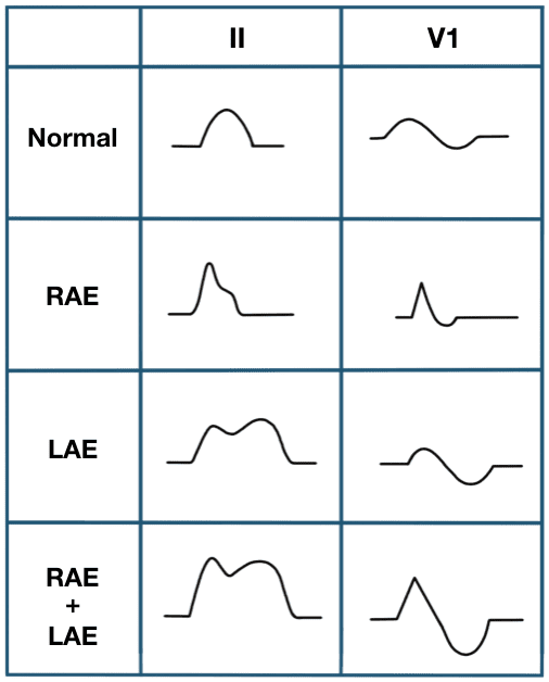Normal and abnormal P wave ECG examples