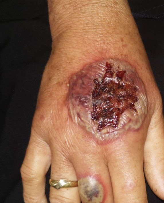 PG Ulcer