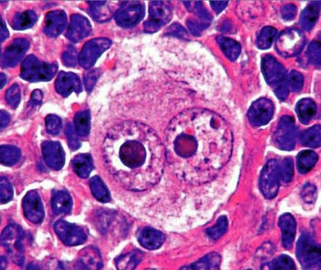 Reed-Sternberg Cell