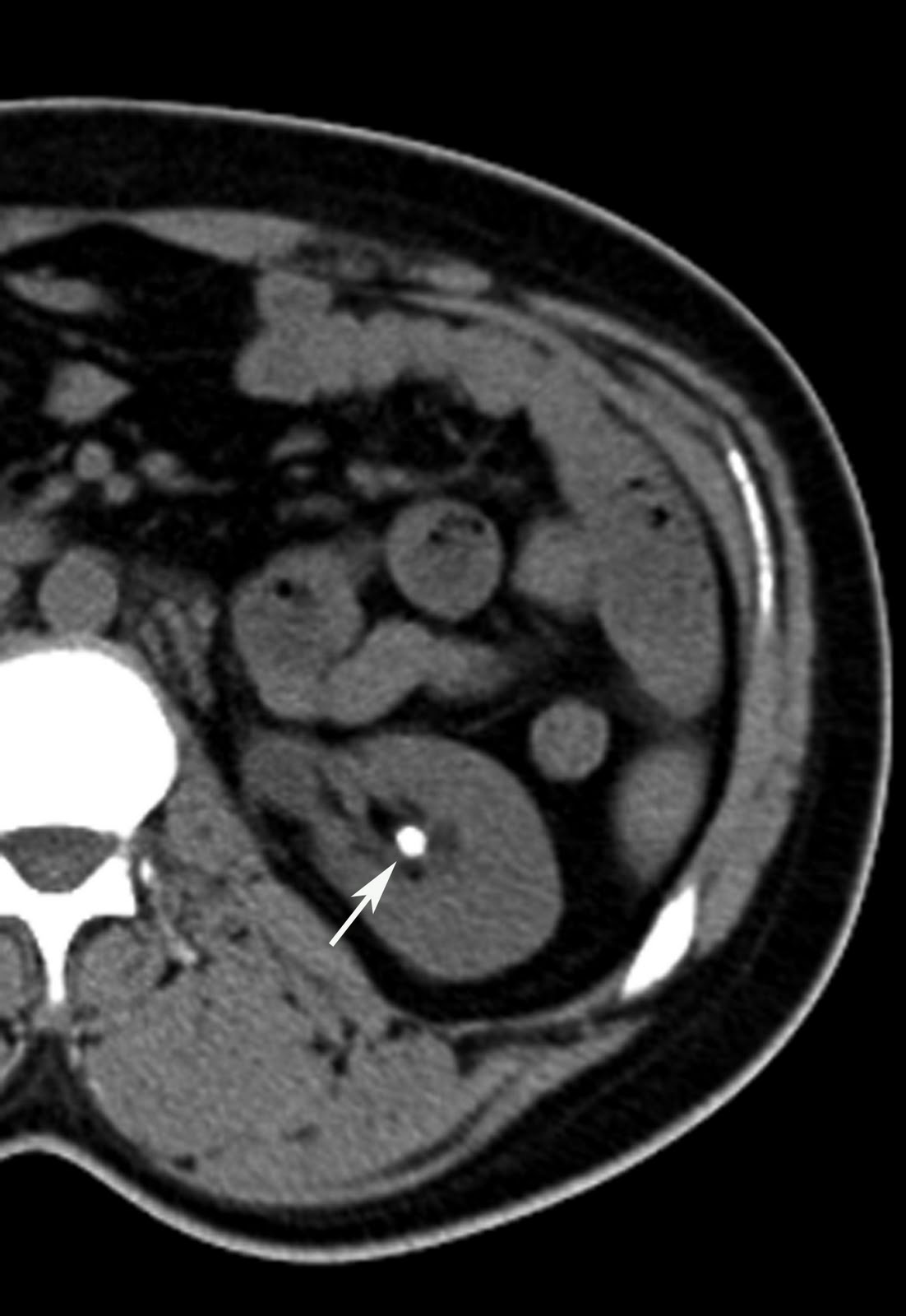 Left renal calculus