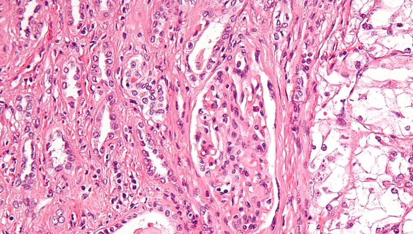 Renal Cell Carcinoma Image