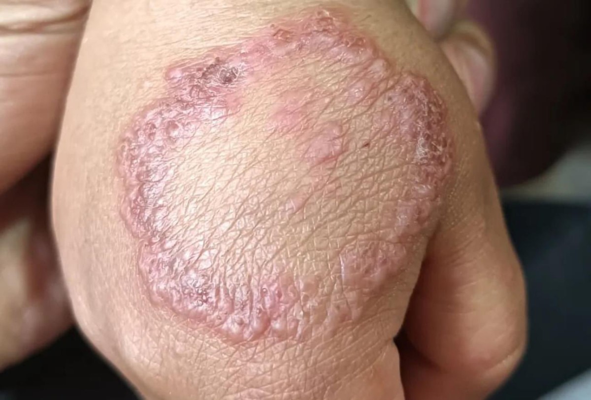 Tinea corporis 2
