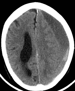 Large subacute subdural haematoma on CT scan