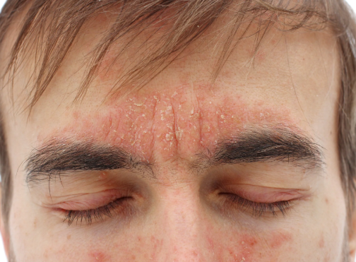 Seborrhoeic dermatitis image