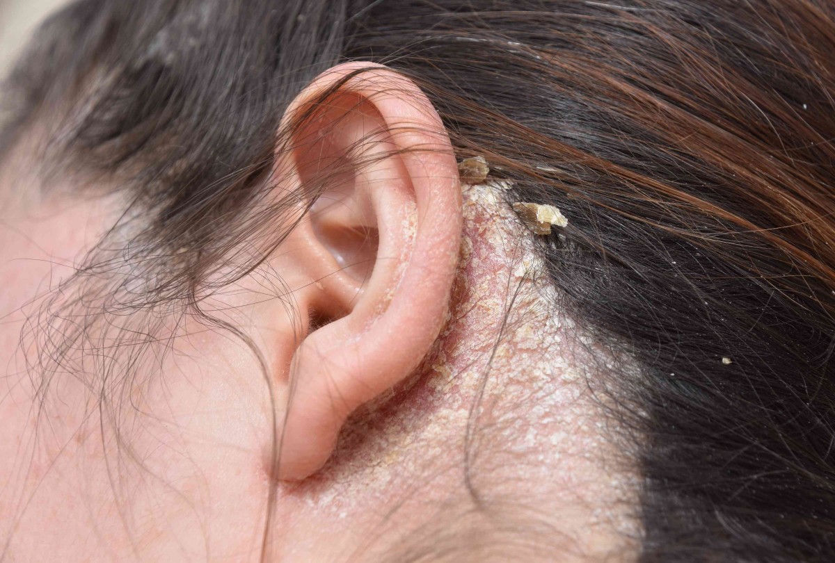 Seborrhoeic dermatitis scalp