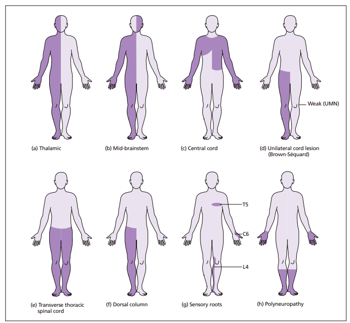 Patterns of Sensory Loss