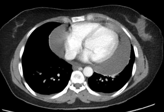 Pericardial Effusion Illustration