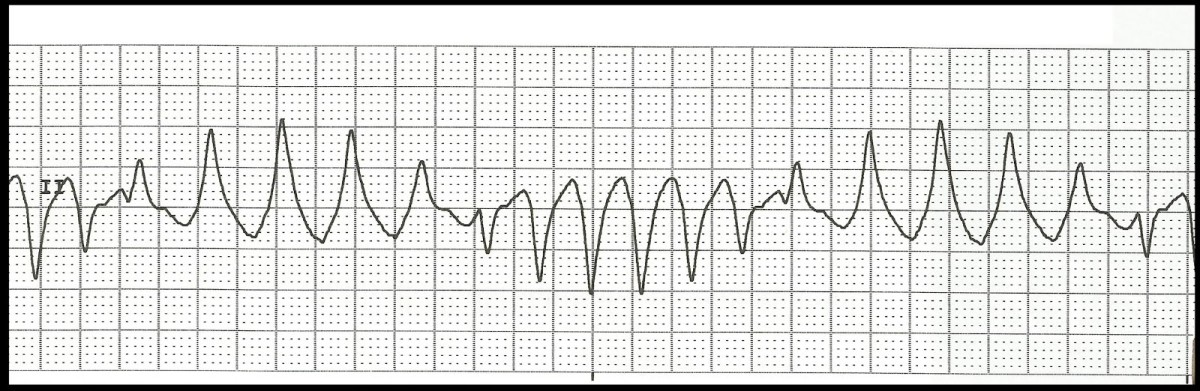 TdP ECG example