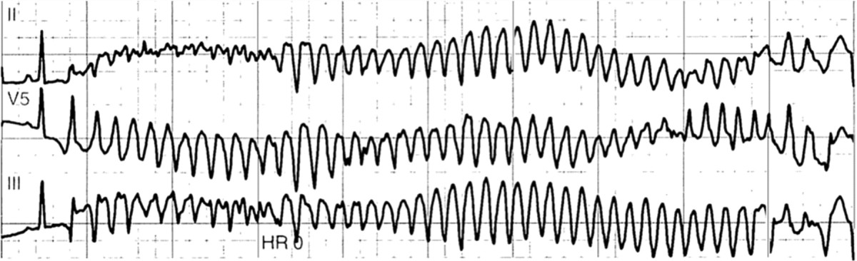TdP ECG second example