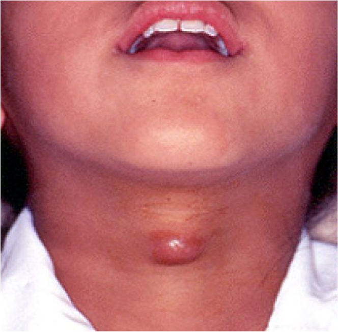 Thyroglossal Cyst Diagram