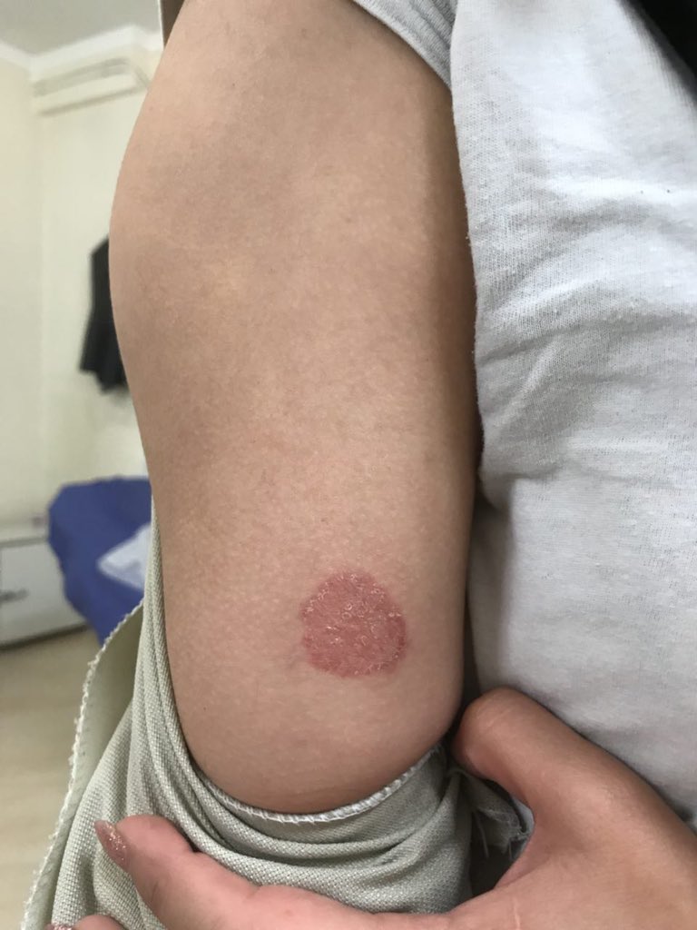 Tinea corporis 1