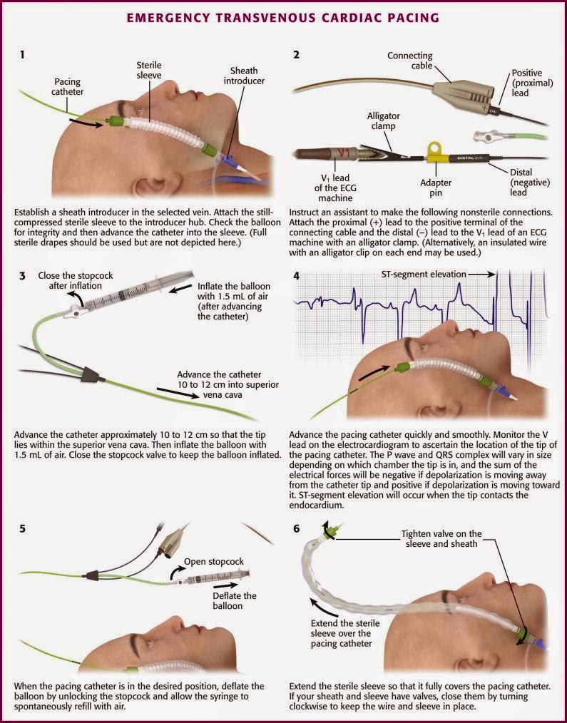 Temporary pacing wire insertion diagram